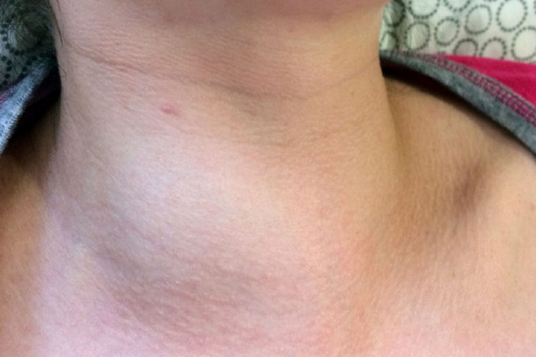 В КДФ оперируют щитовидную железу инновационными хирургическими инструментами