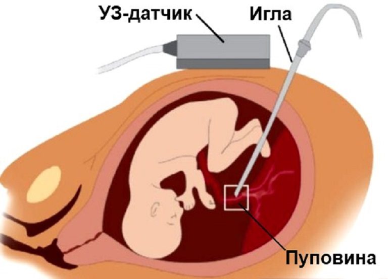 В Тверском областном Перинатальном центре имени Е.М.Бакуниной начали проводить кордоцентез