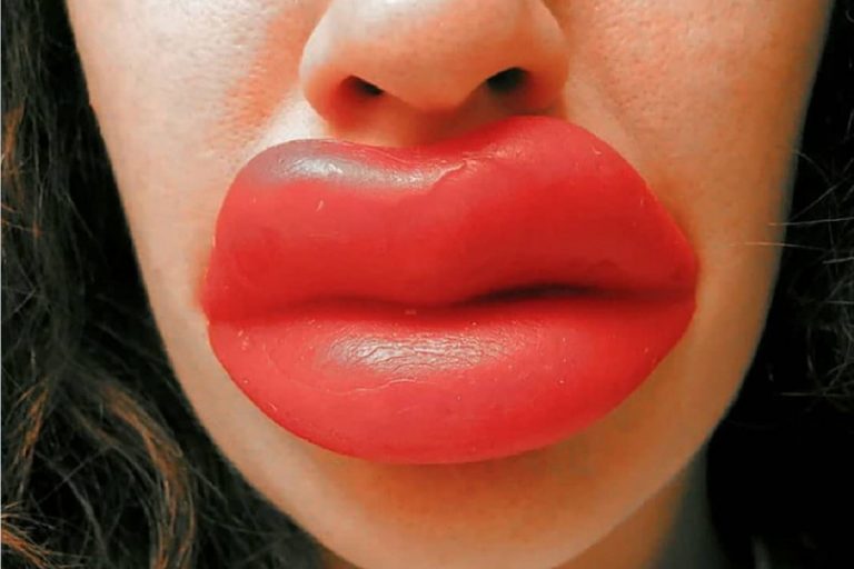 Россиянкам до 18 лет предлагают законодательно запретить накачивать губы