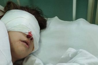 В Тверской области немецкая овчарка искусала лицо 10-летней девочки В Тверской области немецкая овчарка искусала лицо 10-летней девочки