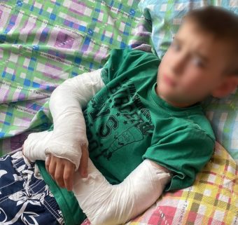 Под Тверью в пришкольном лагере ребёнок сломал обе руки