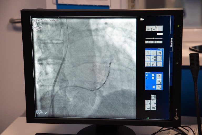 В Тверской ОКБ развивается помощь пациентам с мерцательной аритмией